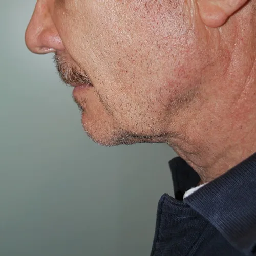 Soy joven y tengo líneas en el cuello, ¿por qué? | Dr. Abulafia